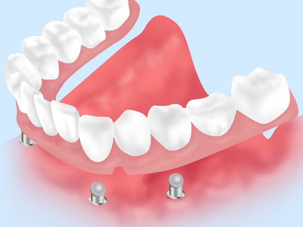 入れ歯とインプラントを組み合わせた方法